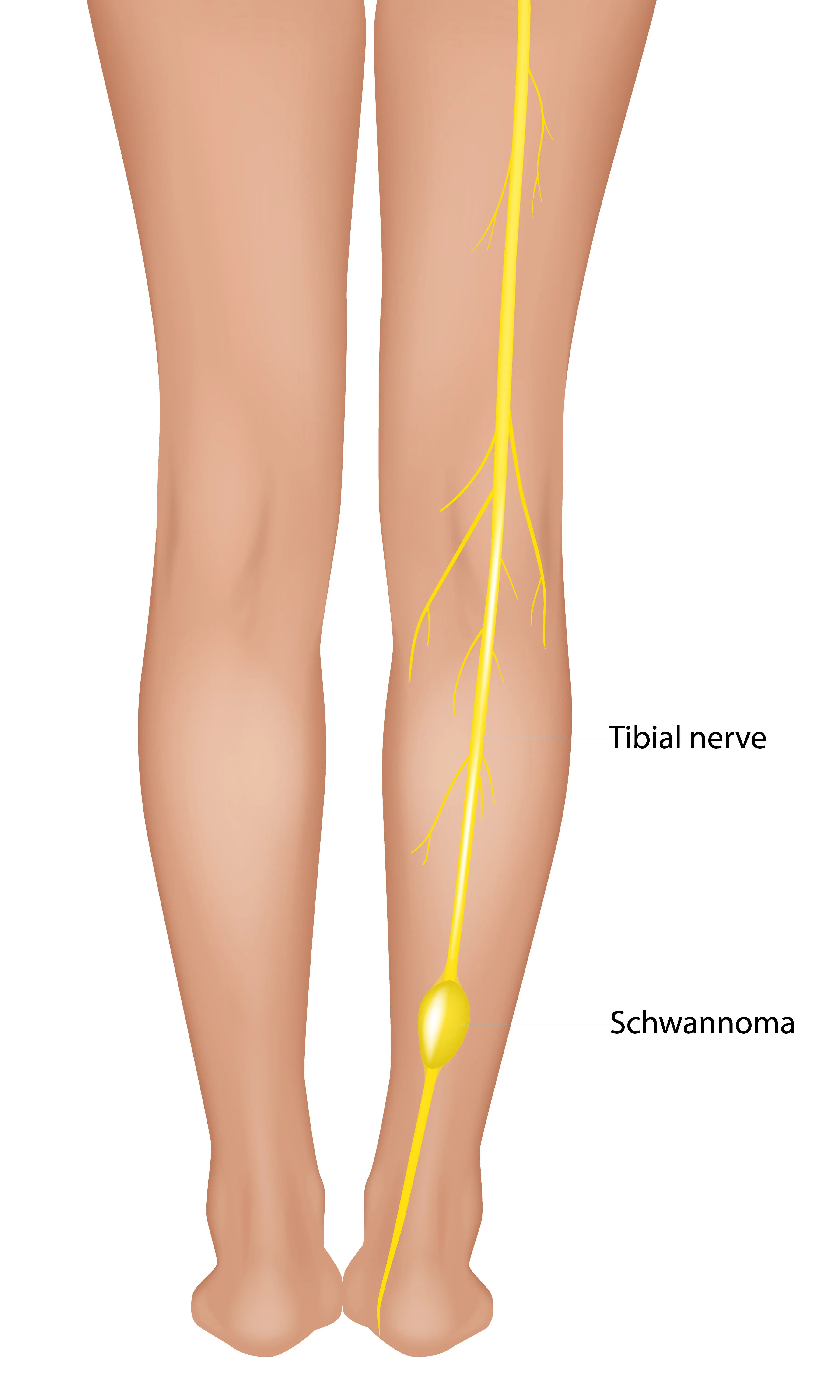 Found a Lump on Your Arm or Leg Your Essential Guide